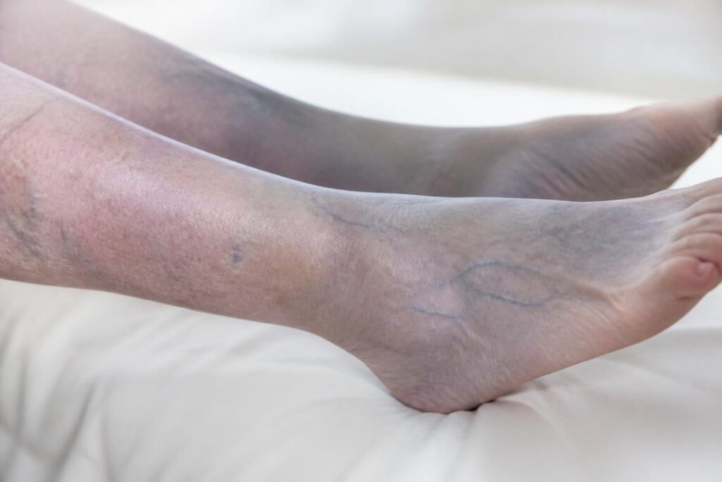 découvrez les principales causes du bleu sur les jambes et comment réagir rapidement pour soulager et prévenir ce phénomène fréquent.