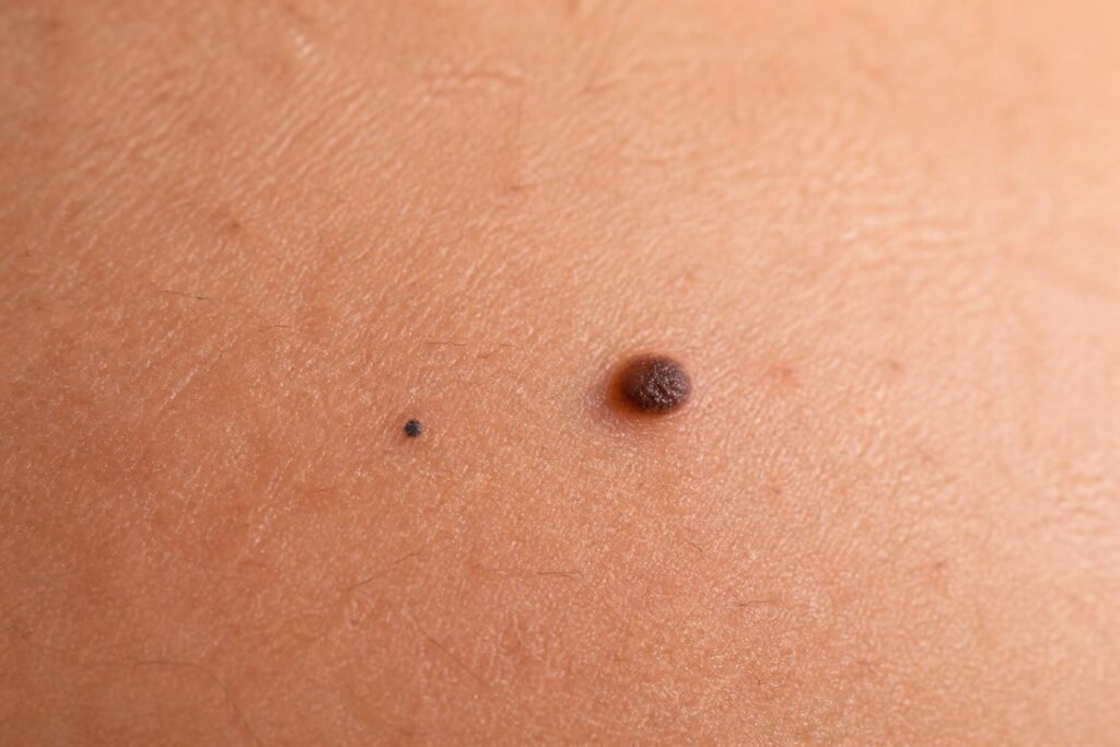 découvrez comment différencier un bouton noir sur la peau, qu'il s'agisse d'un point noir ou d'un grain de beauté, et apprenez les gestes essentiels pour prendre soin de votre peau en toute sécurité.